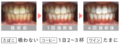 ホワイトニングカフェで白くならない？必須のチェックポイント